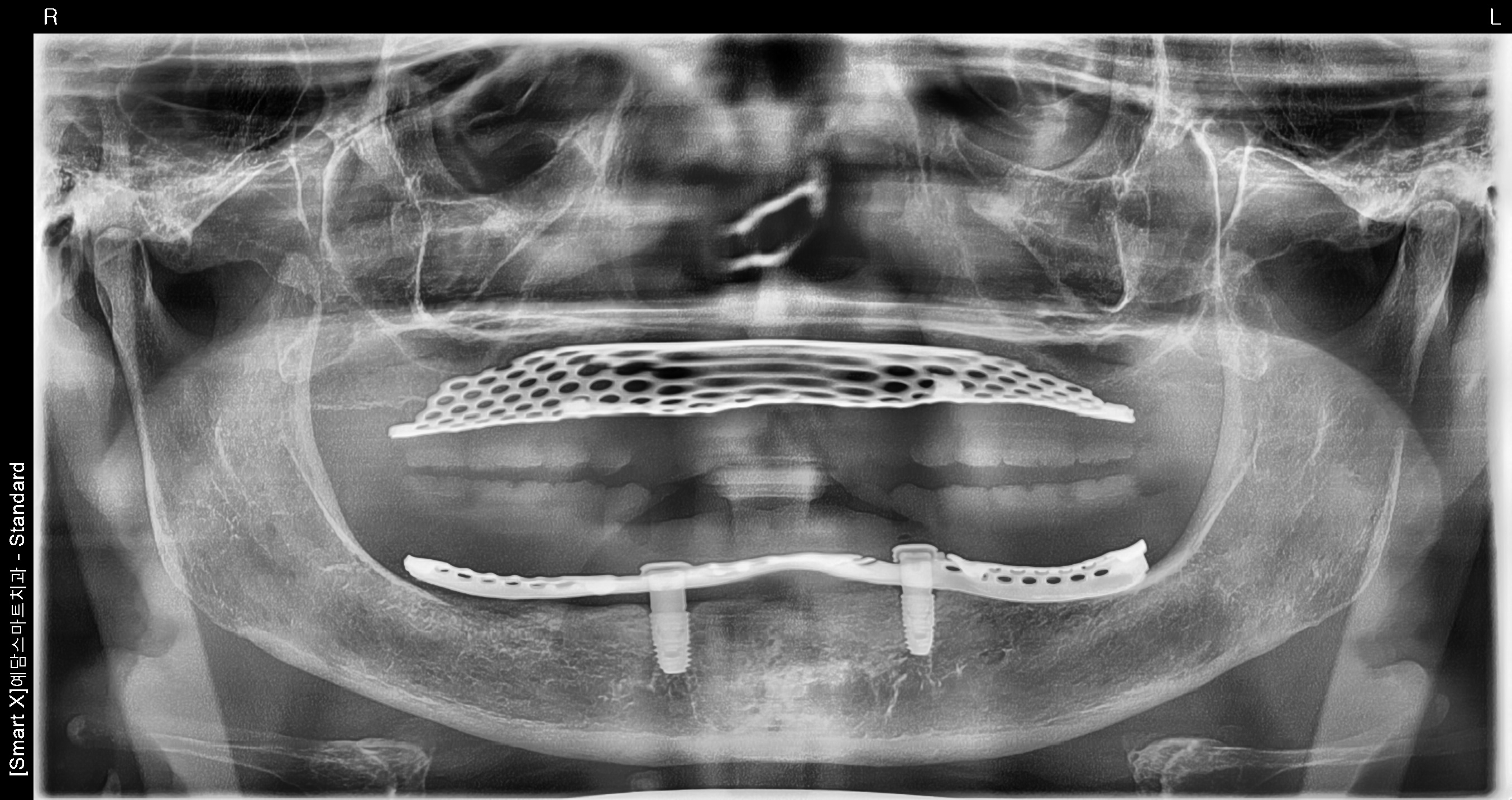 Case Study: Overdenture Restoration using Maxillary Complete Denture and 2 Mandibular Implants After