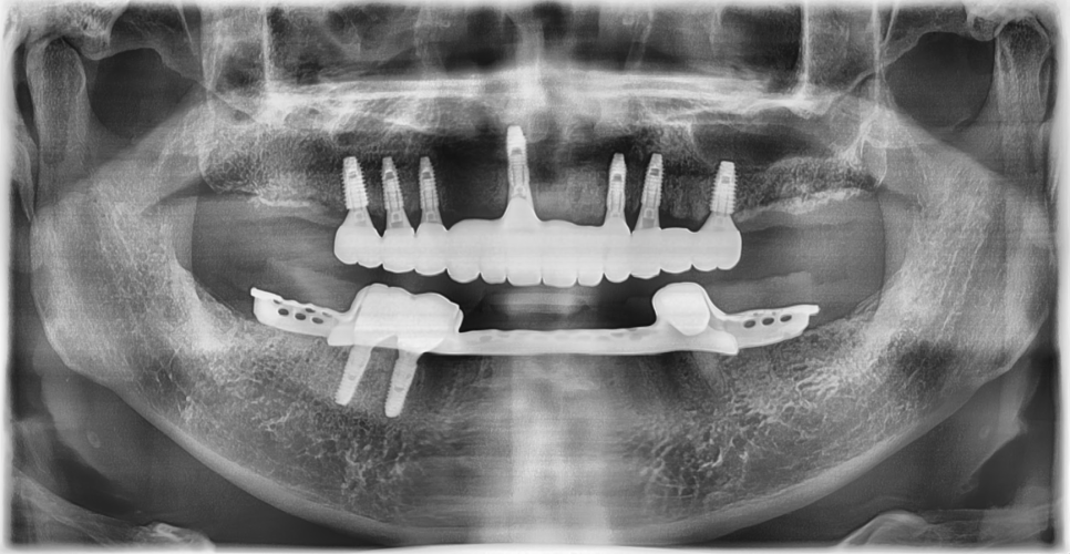 Case Study: Full-Arch Restoration Using Maxillary Full-Arch Implants and Mandibular Partial Dentures After