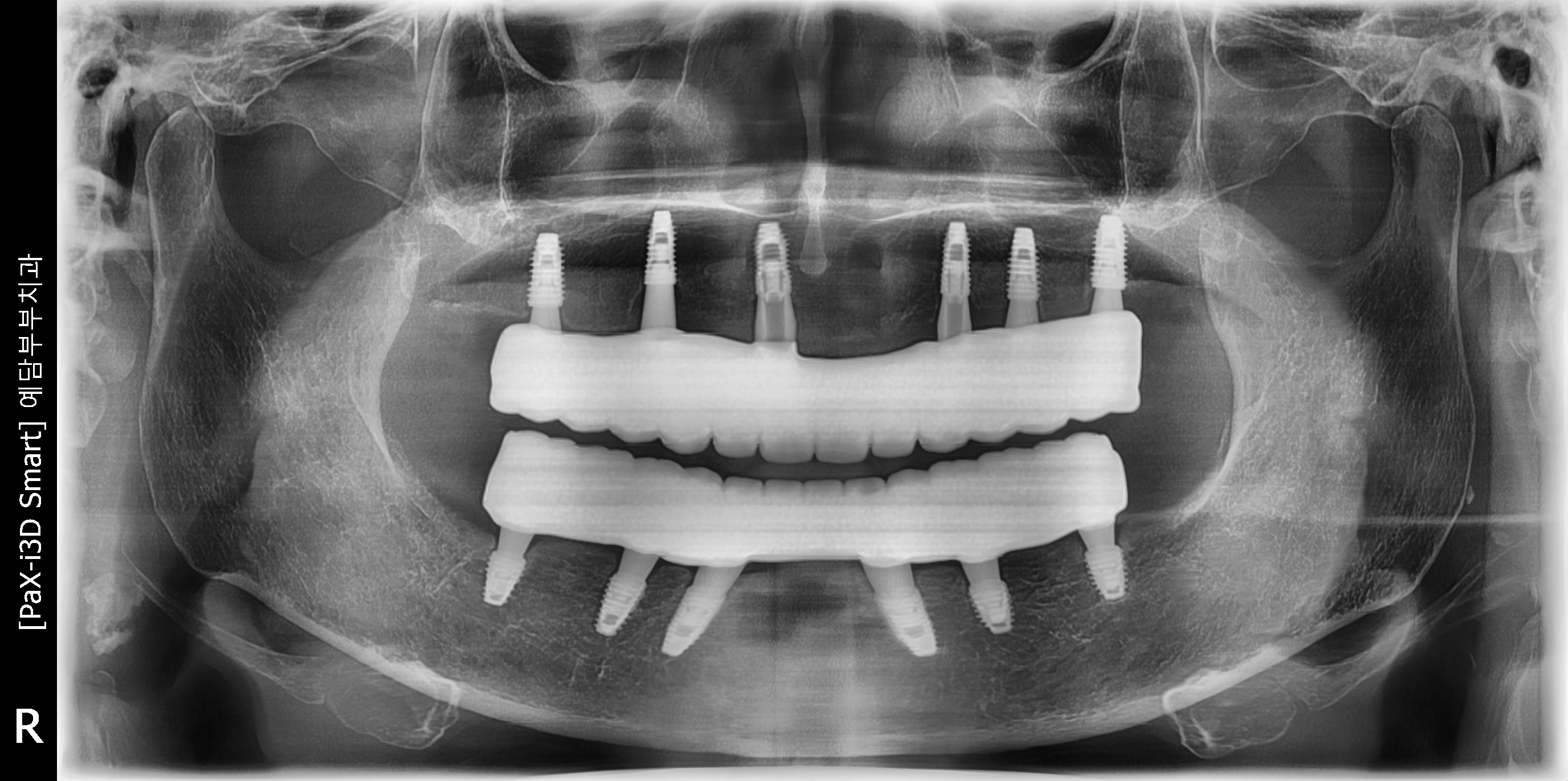 Case Study: Full-Arch Digital Implant Restoration for Reduced Occlusal Vertical Dimension Due to Long-Term Denture Use After