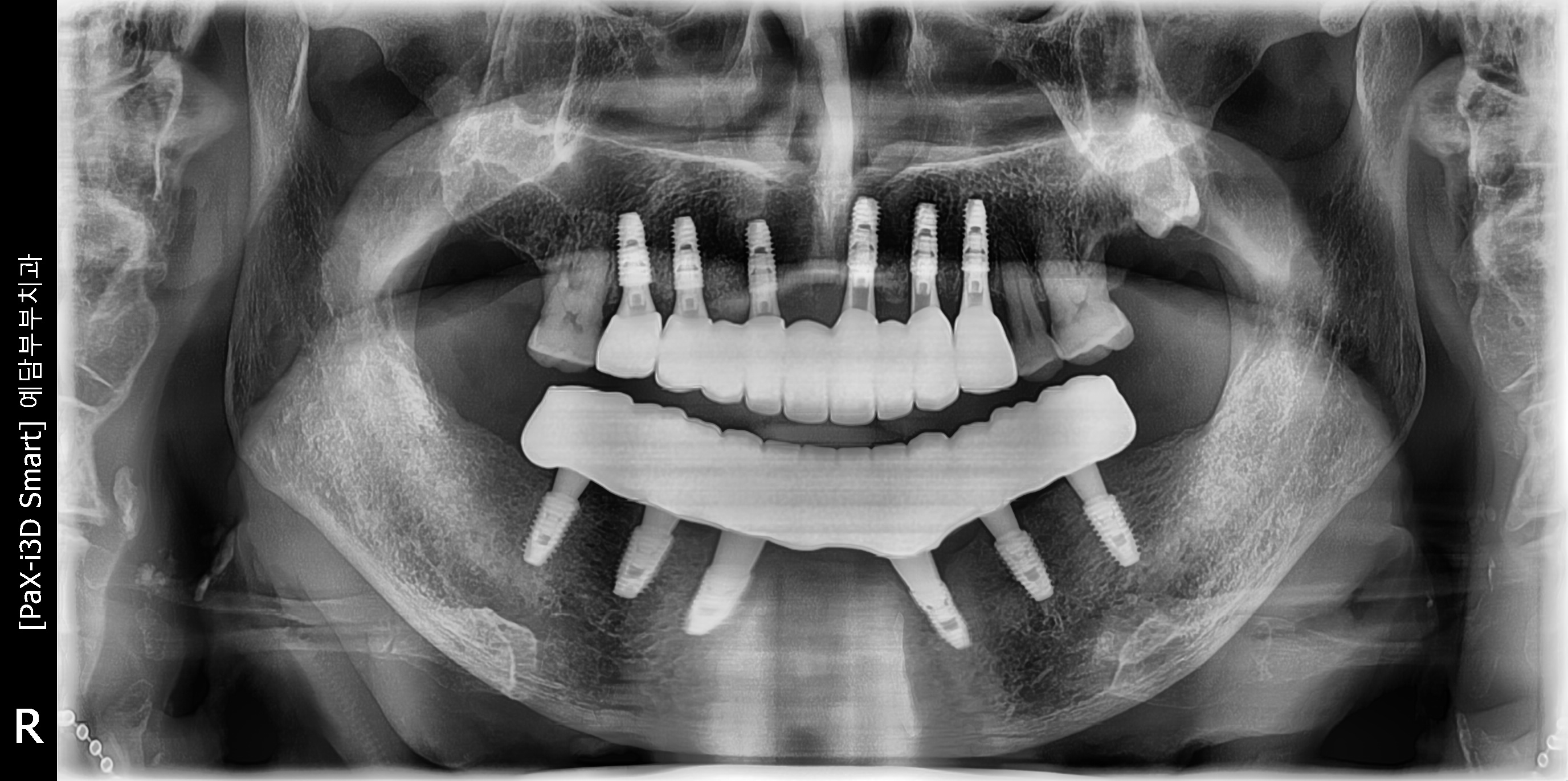 Case Study: Full-Arch Implant Restoration for Collapsed Occlusion Due to Severe Periodontitis and Root Caries After
