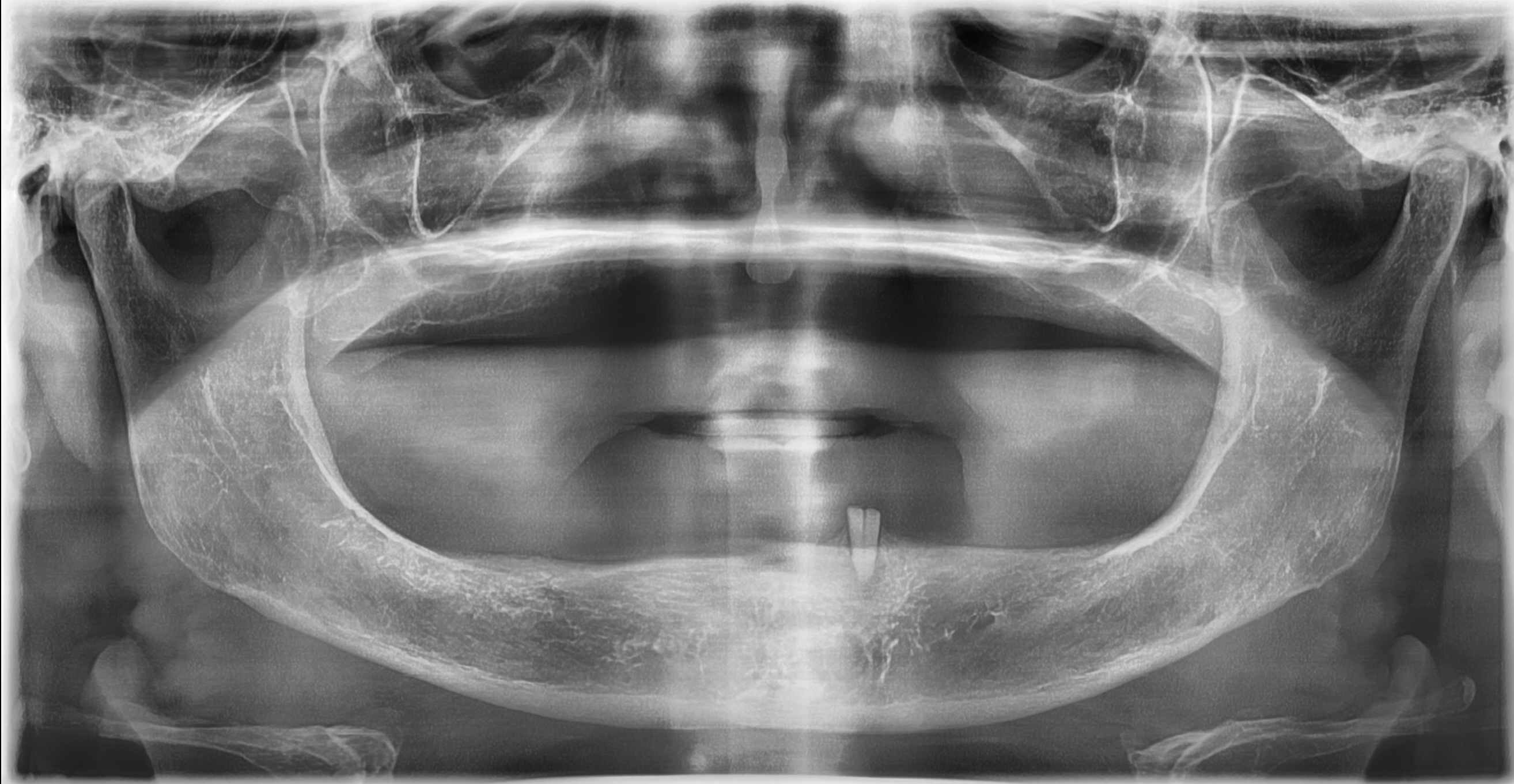 Case Study: Overdenture Restoration using Maxillary Complete Denture and 2 Mandibular Implants Before