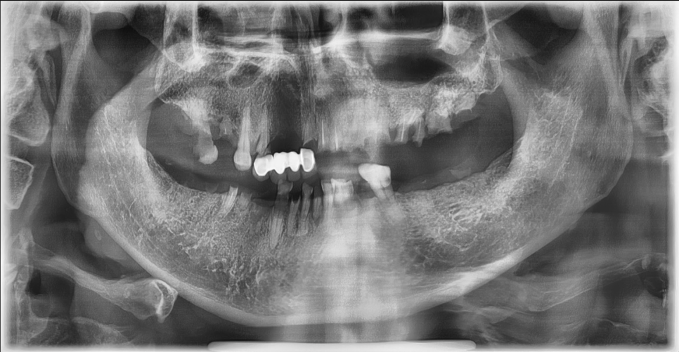 Case Study: Full-Arch Restoration Using Maxillary Full-Arch Implants and Mandibular Partial Dentures Before
