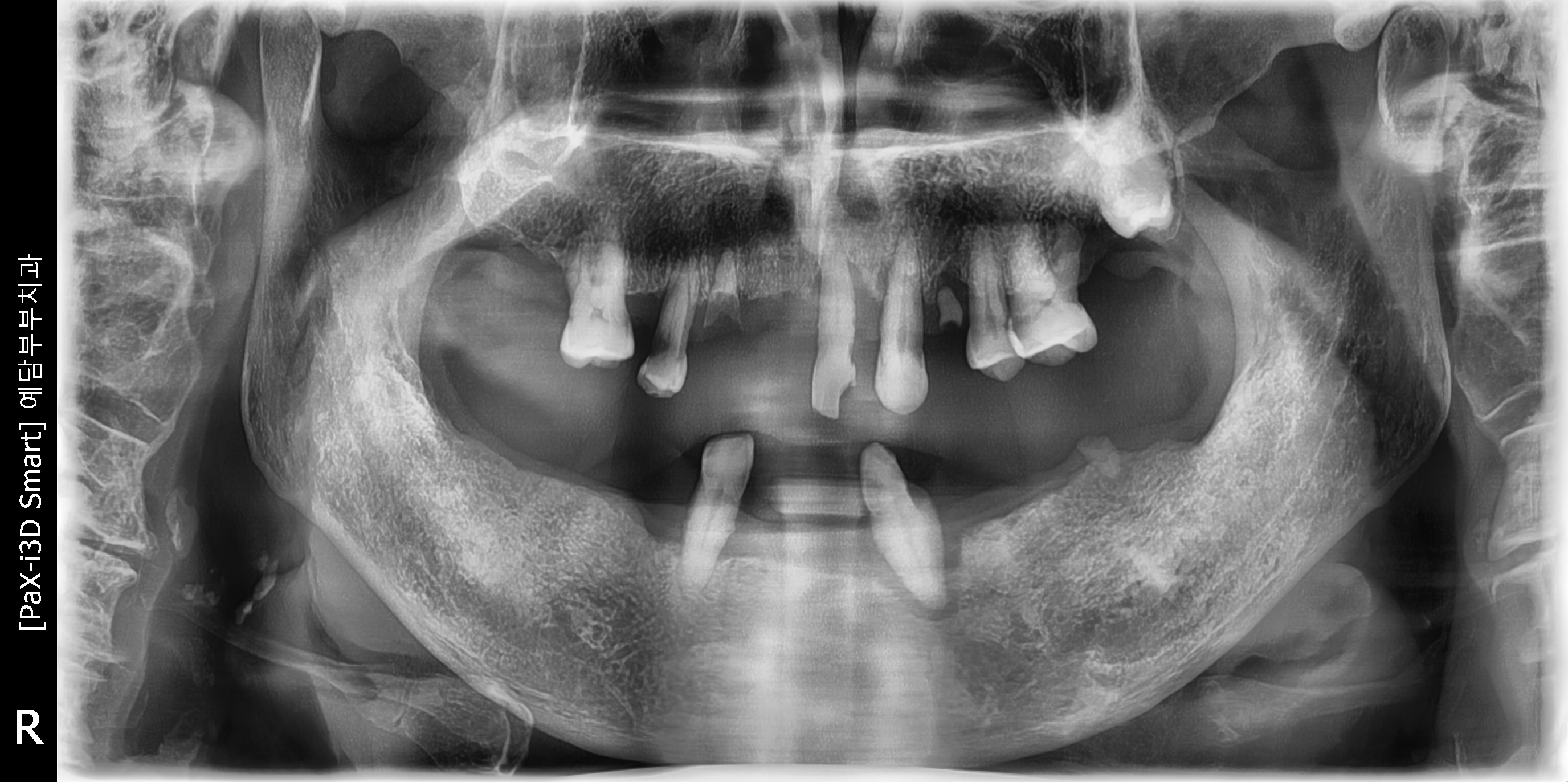 Case Study: Full-Arch Implant Restoration for Collapsed Occlusion Due to Severe Periodontitis and Root Caries Before