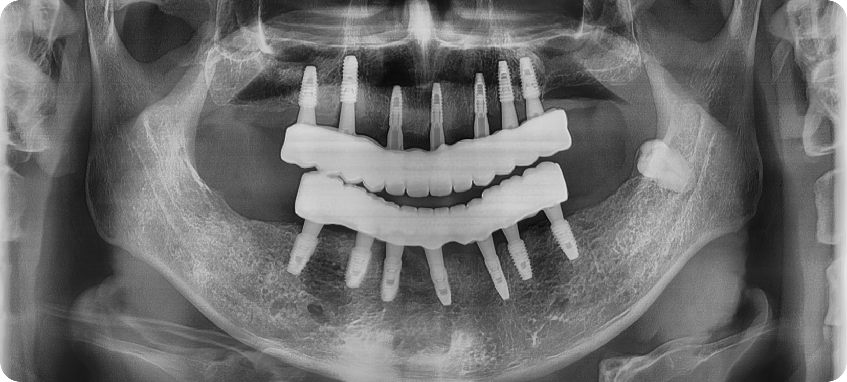 Case of full arch implants instead of dentures. After
