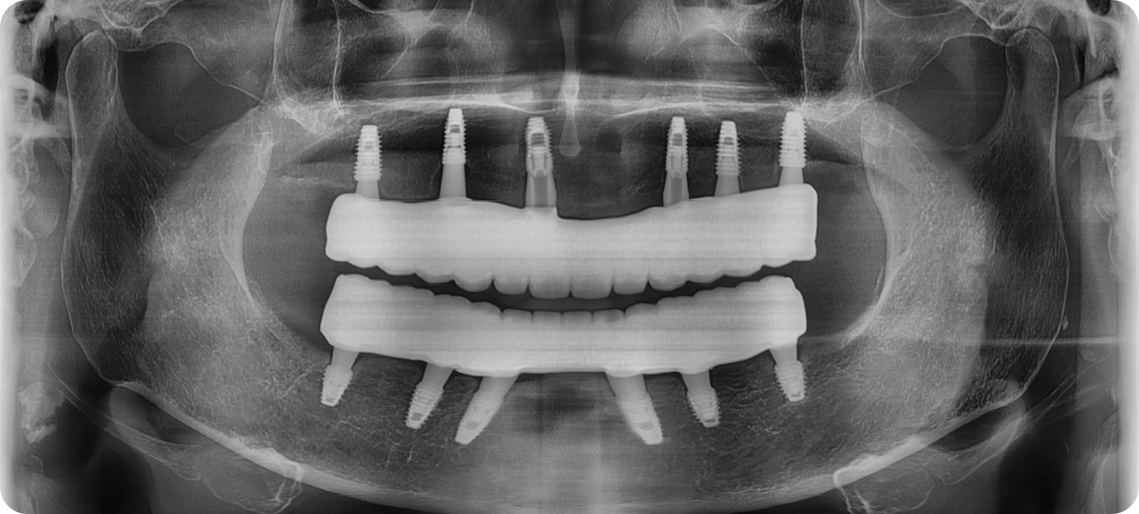 Case of full arch bone graft implants for gums damaged by periodontitis. After