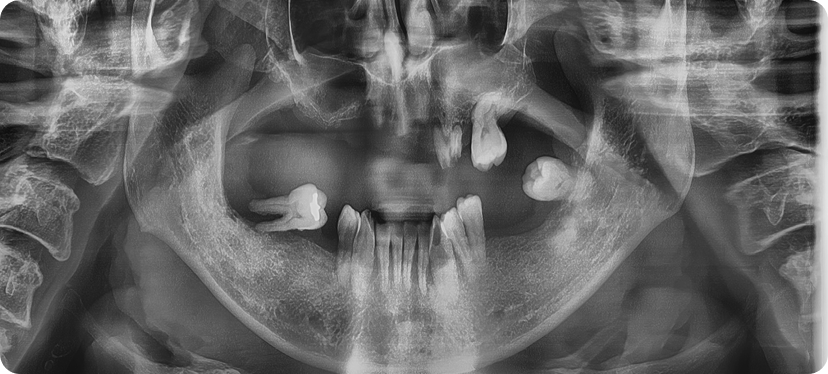 Case of full arch implants instead of dentures. Before