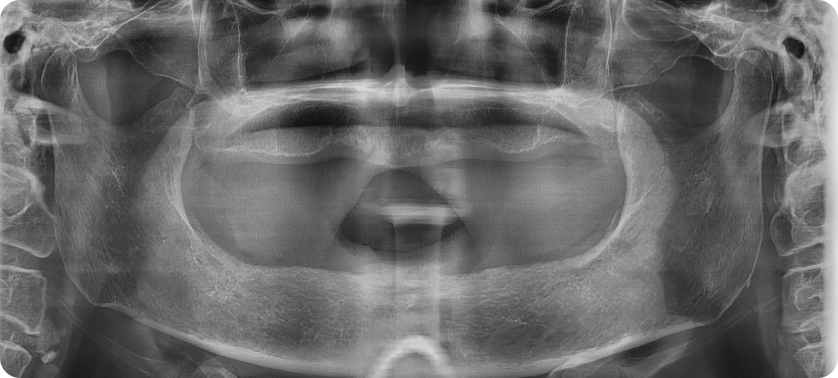 Case of full arch bone graft implants for gums damaged by periodontitis. Before