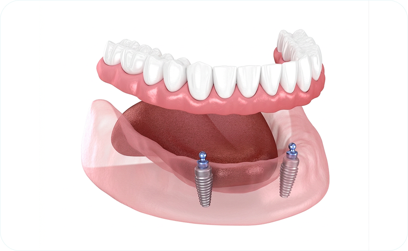 Overdenture (Implant-Retained Denture)